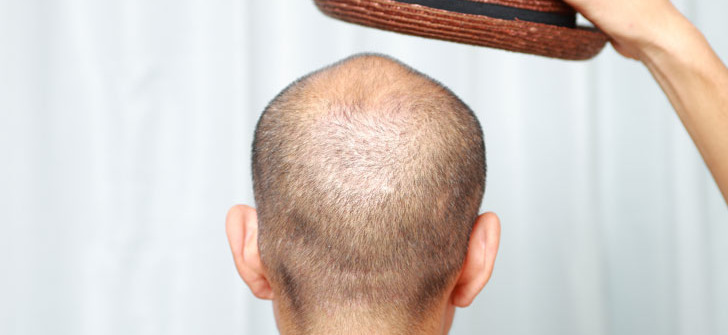 Трихопигментация волос (татуаж скальпа)